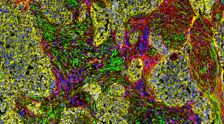 Bispezifische Antikörper für die Krebstherapie: Bindegewebe des Tumors im Visier