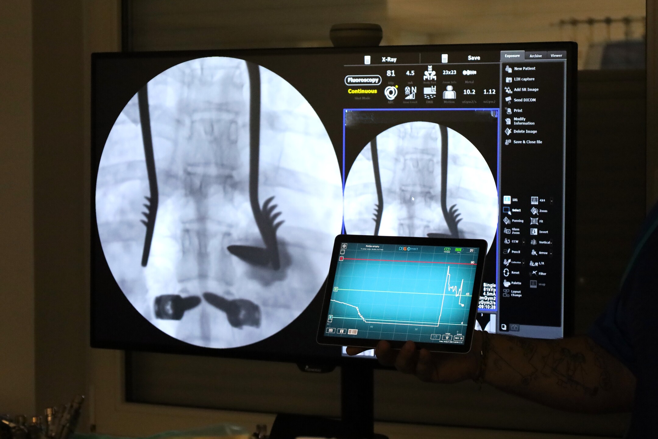Žilinská nemocnica použila ako prvá nový robotický navigačný systém