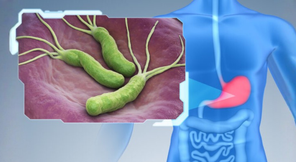 Helicobacter pylori podría estar detrás de uno de cada cinco casos de cáncer colorrectal