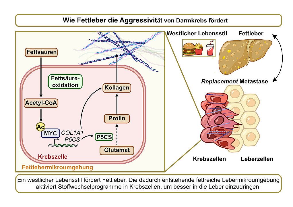 Veröffentlichung in Nature Fettleber begünstigt aggressive Form von Lebermetastasen bei Darmkrebs