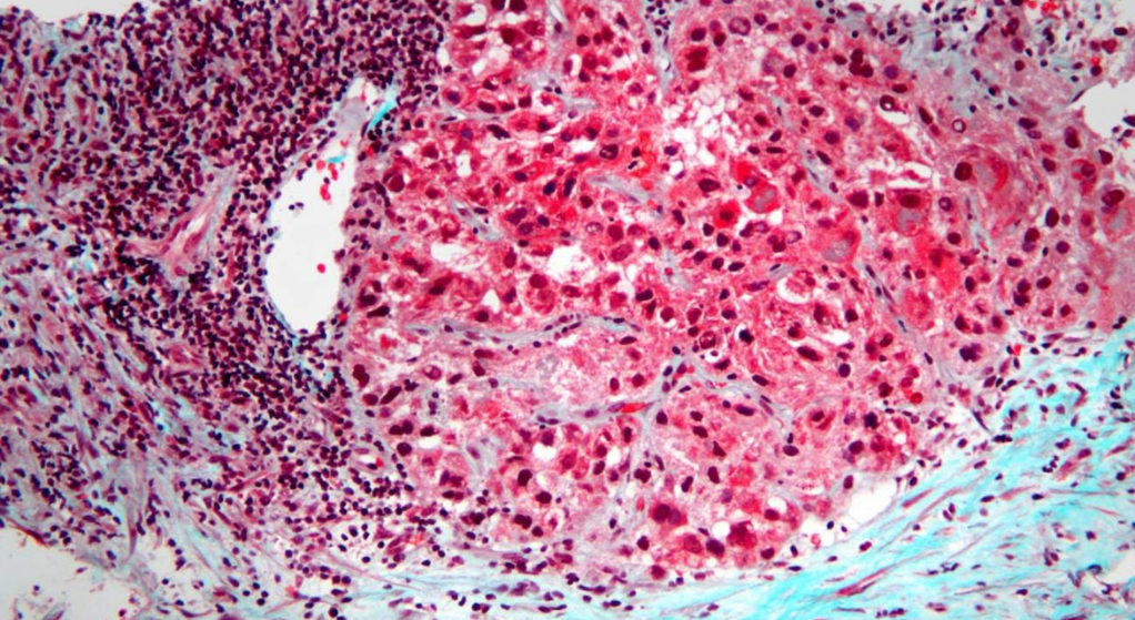 Un fármaco usa la glucosa para frenar la expansión del cáncer en ratones