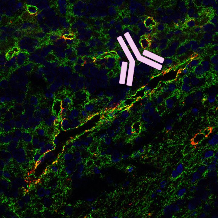 Seltene neurologische Autoimmunerkrankung: MLC1-Antikörper als möglicher Auslöser identifiziert