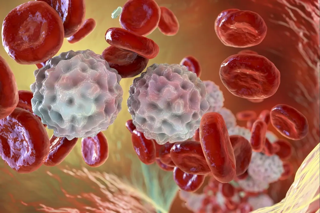 Lupus: effets encourageants de l’anifrolumab sur les anomalies du sang